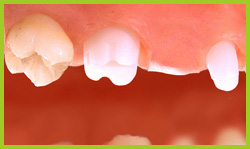 2. A fogak preparálása