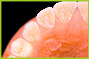 I materiali di fotopolimerizzazione vengono utilizzati soprattutto per il restauro dei denti frontali.