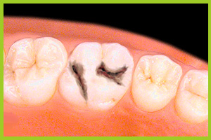 I materiali vetroionomero di chemopolimerizzazione vengono inseriti nelle cavita dei molari e dei denti premolari di un volume minore.