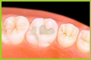 I materiali vetroionomero di chemopolimerizzazione vengono inseriti nelle cavita dei molari e dei denti premolari di un volume minore.